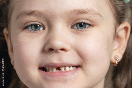 Portrait of a little girl with fallen and broken baby teeth photo