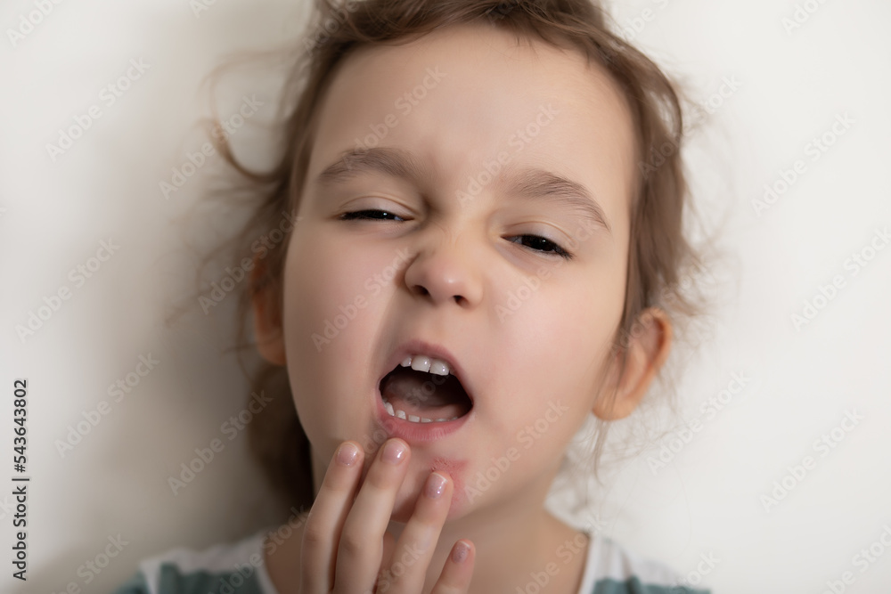 Wounds, scratches, abrasions on the kid girl skin face. Wounds, scratches, abrasions on the kid girl skin face.