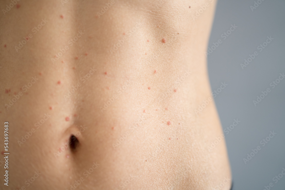 Woman Body Skin With Red Allergy Eruption Woman Body Skin With Red Allergy Eruption