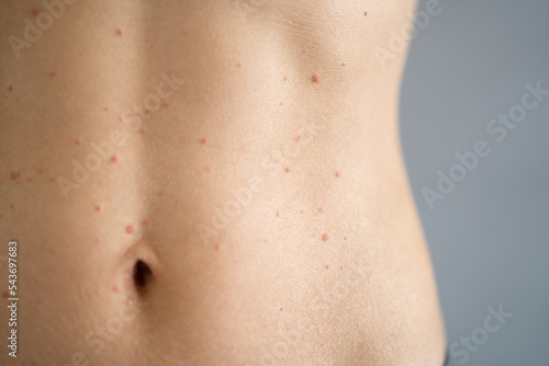 Woman Body Skin With Red Allergy Eruption