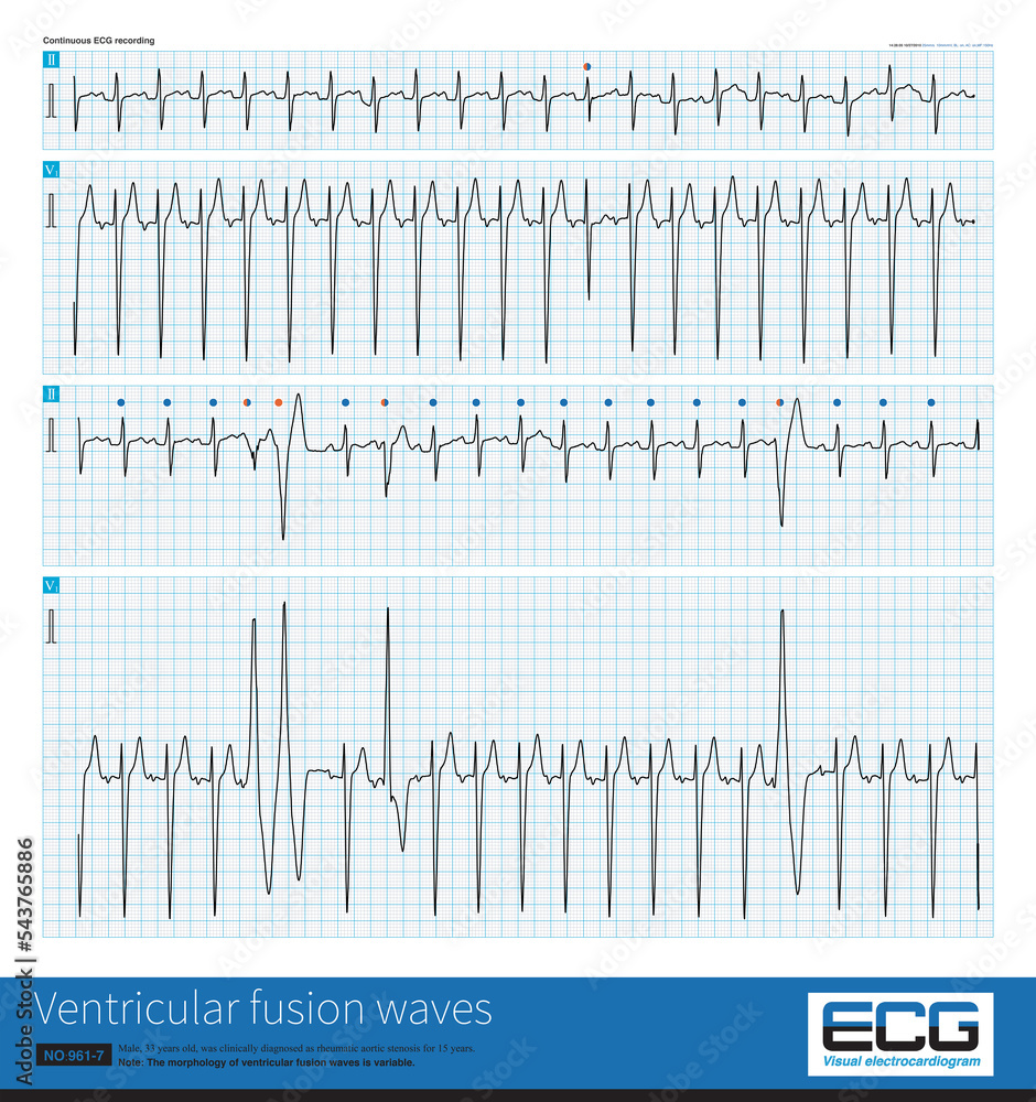 Ventricular premature contractions in late diastole can be combined ...
