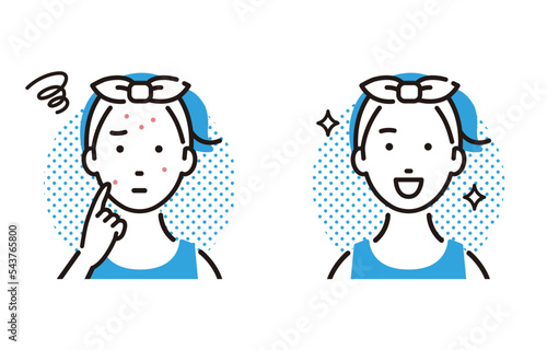 ニキビ、肌荒れが改善した女の子