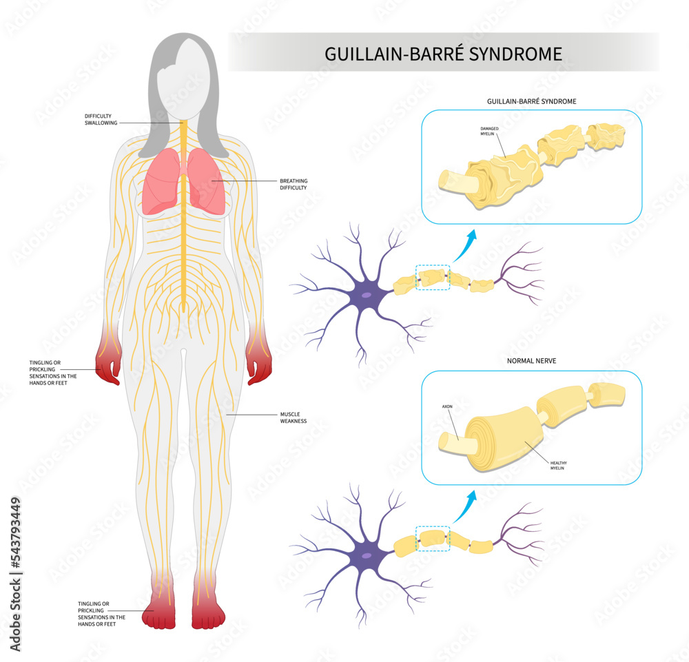 Demyelinating system disease acute sclerosis Guillain Barré syndrome