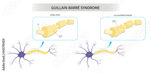 Guillain Barré syndrome limb muscle autonomic numbness tingling disease demyelinating system COVID 19 virus infection pain feet hand arm dysfunction lupus lateral Acute sclerosis stroke bell's palsy
