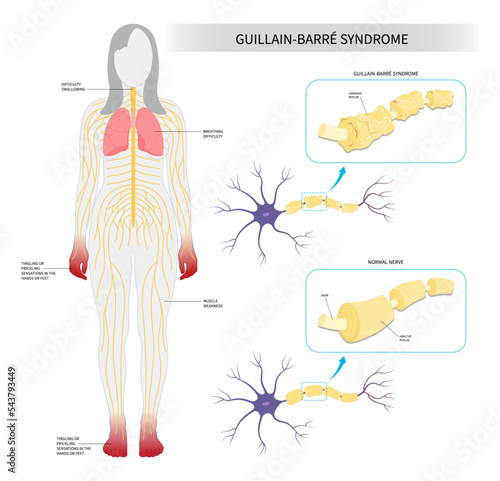 Demyelinating system disease acute sclerosis Guillain Barré syndrome limb muscle autonomic numbness tingling COVID 19 virus infection bell's palsy pain feet hand arm dysfunction lupus lateral stroke photo