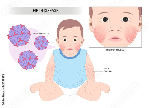 Fifth disease facial reaction slapped cheek child toddler human herpes viral with NICU Neonatal Intensive Care Unit
