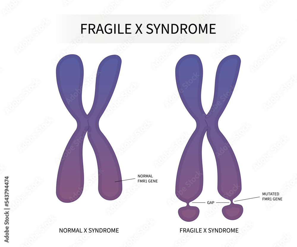Fragile X Syndrome Testing Fragiles X Syndrom Pr nataldiagnostik RUAUE Fragile X Syndrome Testing Fragiles X Syndrom Pr nataldiagnostik RUAUE