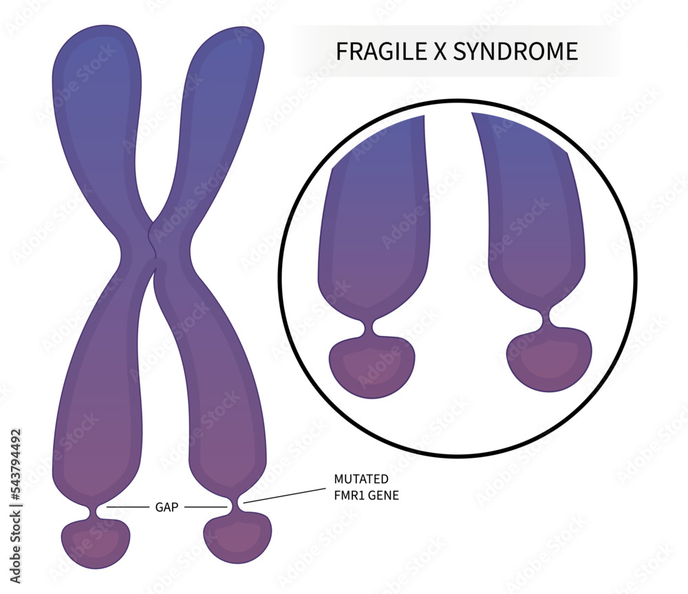 DNA disorder testing of Fragile x syndrome with ADHD and for elongated
