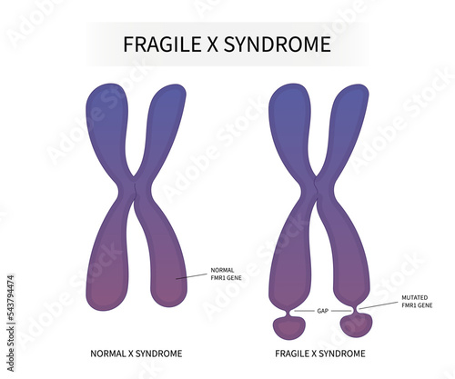DNA testing for Fragile x syndrome with ADHD and elongated face flat feet protruding ears inherited health depression forehead disability prominent jaw photo