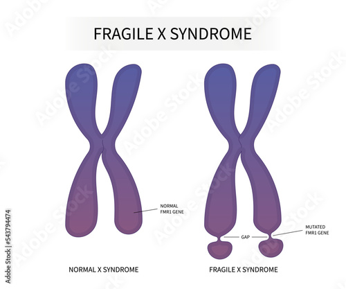 DNA testing for Fragile x syndrome with ADHD and elongated face flat feet protruding ears inherited health depression forehead disability prominent jaw