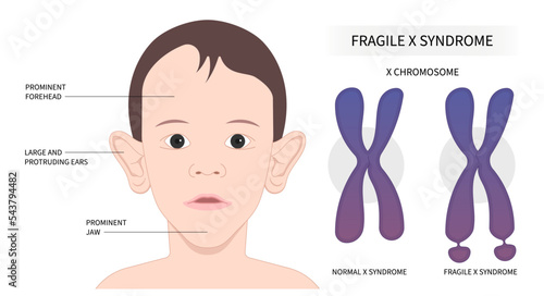 Fragile x syndrome with ADHD disorder and DNA testing for elongated face flat feet protruding ears inherited health depression forehead disability prominent jaw photo