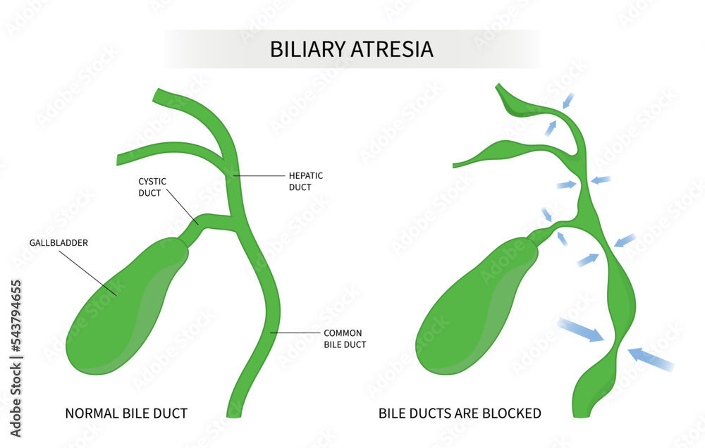 Biliary atresia bile duct blocked Primary acute choledochal cyst stone