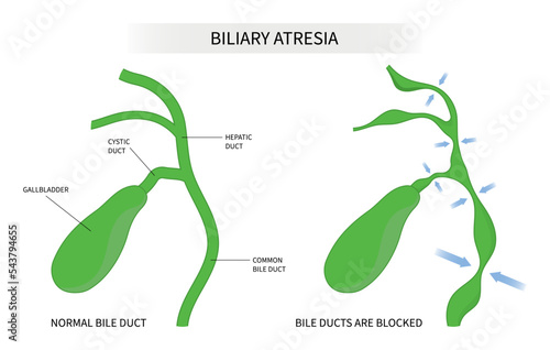 Biliary atresia bile duct blocked Primary acute choledochal cyst stone obstructive damage bilirubin level acid test scan ascites yellowing skin Acholic stool liver pain fatal enlarged spleen infection