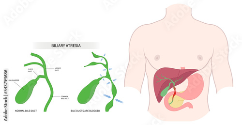 acute infection bile duct blocked Choledochal cyst obstructive fatal enlarged spleen Biliary atresia Primary stone damage bilirubin level acid test scan ascites yellowing skin Acholic stool liver pain photo