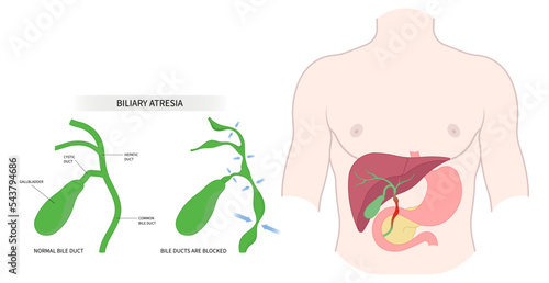 acute infection bile duct blocked Choledochal cyst obstructive fatal enlarged spleen Biliary atresia Primary stone damage bilirubin level acid test scan ascites yellowing skin Acholic stool liver pain
