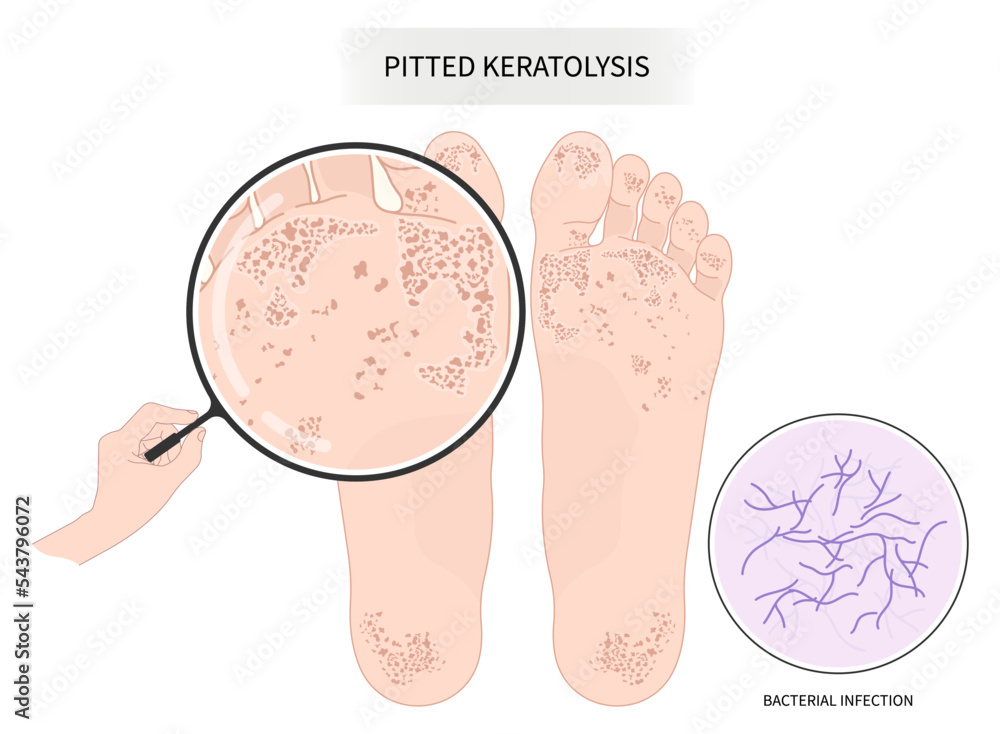 Toe foot poor foul odor itchiness with pitted keratolysis athlete's