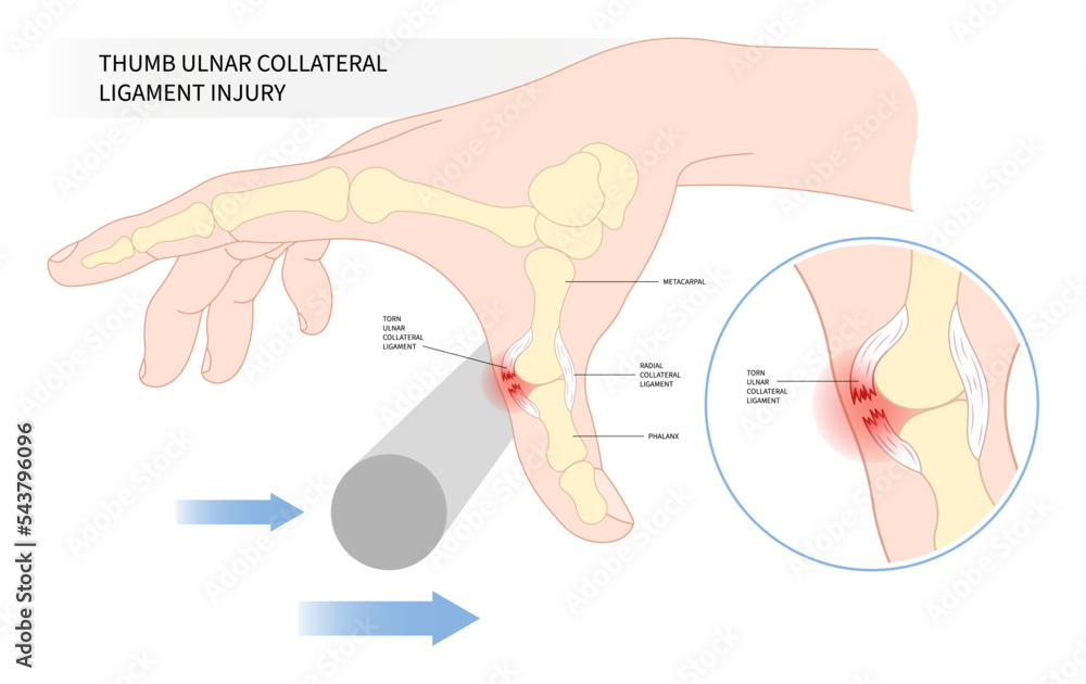 Plakat Gamekeeper's or Skier's and finger thumb pain with