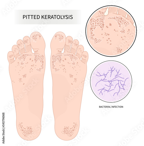 pitted keratolysis athlete's foot fungal heel wet cold skin  toe bacteria poor foul odor itchiness Sweat small hole footwear Basal cell rash Focal acral hyperkeratosis sore warts deep