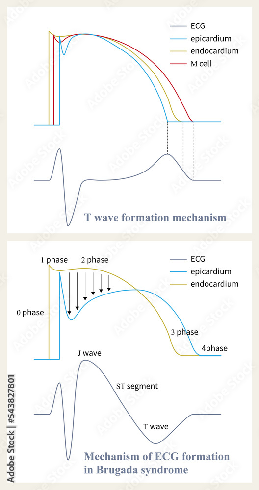 The mechanism of Brugada syndrome is the difference of repolarization phase 1 and phase 2