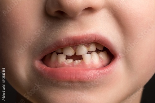 Milk and permanent teeth. baby mouth close-up.