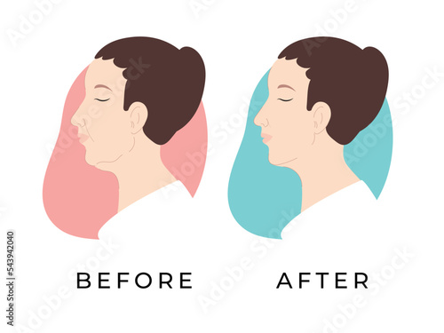Woman profile. Female face before and after receiving hardware cosmetology procedure. Double chin. Woman face. Vector illustration