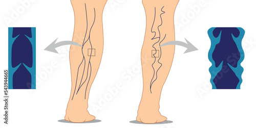 Varicose veins illustration. Normal and illness leg with varicose veins illustration