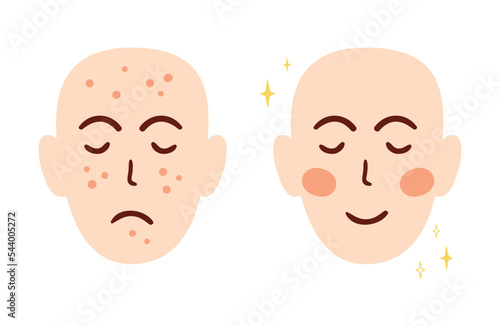 Acne face treatment concept with two different faces before and after. Acne skin problem. Acne scars. Anti acne cosmetic brand character elements isolated on white. Cartoon vector illustration