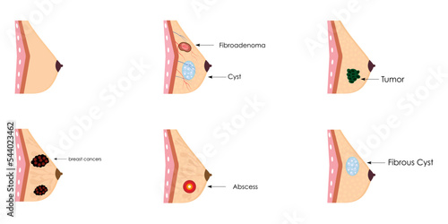 Collection of illustrations of realistic mammary glands. Cysts, cancer, abscess, inflammation, fibroadenoma, pain.