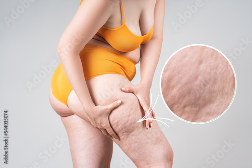 Obesity female legs with cellulite, fat thighs and buttocks with an enlarged area of skin photo