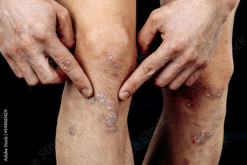 Eczema on the legs. Atopic dermatitis close-up. Allergic spots and red itchy inflammation of the skin on the legs.
