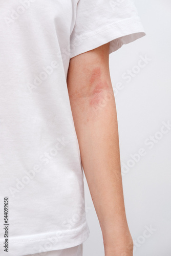 Atopowe zapalenie skóry na ramieniu