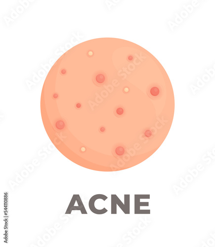 The consequences of poor skin care. Vector illustration of inflamed pimples on the skin. Acne. Dermatological disease. 