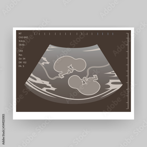 Ultrasound of a twin in the womb. Vector illustration in grayscale. An ultrasound image of a baby. Medicine and health of the fetus of twins. Realistic Embryo Sonogram