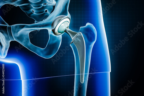 Femoral head hip prosthesis or implant. Total hip joint replacement surgery or arthroplasty 3D rendering illustration. Medical and healthcare, arthritis, pathology, science, osteology concepts.
