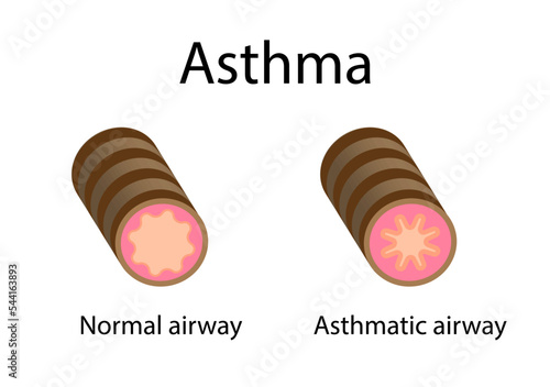 Bronchial Asthma diagram with normal airway and asthmatic airway characterized by narrowing of the airways and dyspnea, wheezing, and coughing. Vector illustration.