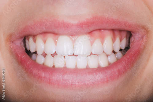 Close Up Of A Teeth Smiling Mouth Of A Woman