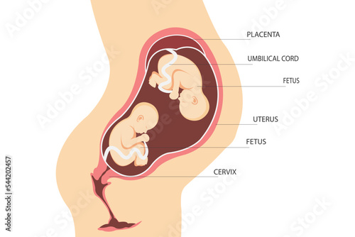 Double pregnancy. Anatomy of the uterus with twin fetuses. Placement of dizygotic twins. flat illustration