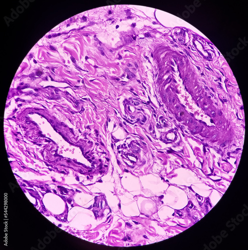 Prepatellar region histology: Chronic bursitis. light microscopic image show soft tissue, tissue dense infiltration of polymorphs, lymphocytes and histiocytes with fibrosis. photo