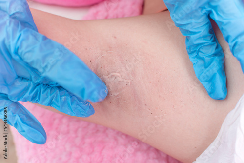 Slika na platnu An esthetician applies serum to the underarm of a patient before a diamond peel