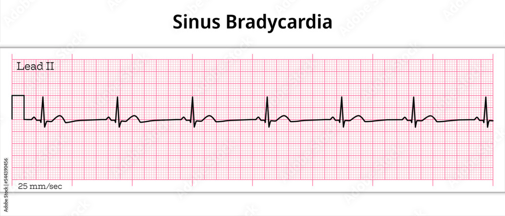 ECG Sinus Bradycardia 8 Second ECG Paper Stock Vector Adobe Stock ecg-sinus-bradycardia-8-second-ecg-paper-stock-vector-adobe-stock