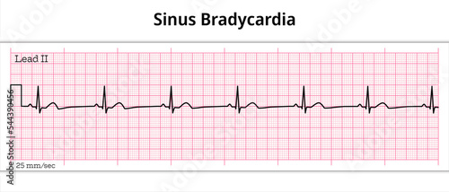 ECG Sinus Bradycardia - 8 Second ECG Paper photo