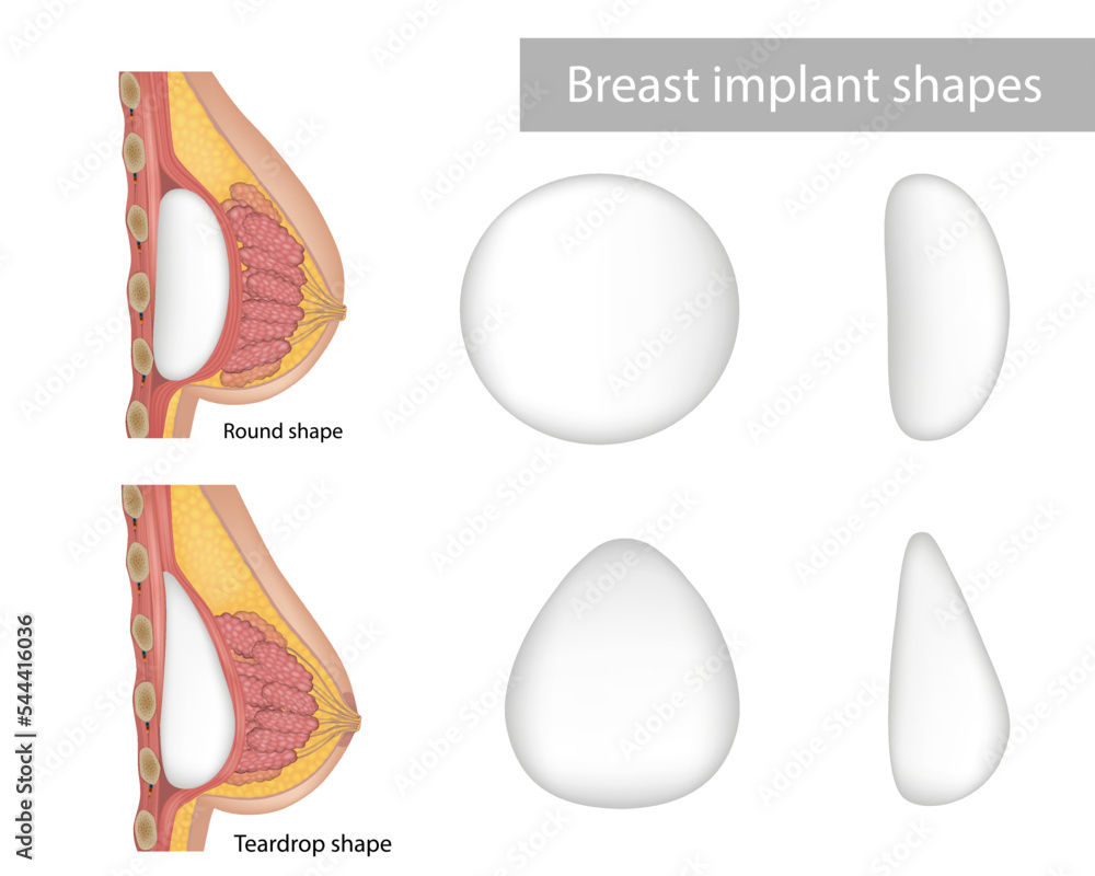 Breast implant shapes Teardrop shape and Round shape. cosmetic surgery.  Bust enhancement result, woman chest after plastic surgery. Breast implant  types. Stock Vector