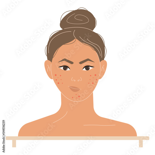 Portrait of a young girl with problematic facial skin, in a flat design. Acne problem on women's skin, problem skin care.