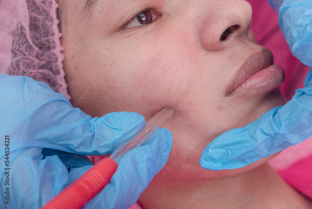 An aesthetician using a pore vacuum to clean and unclog pores on the