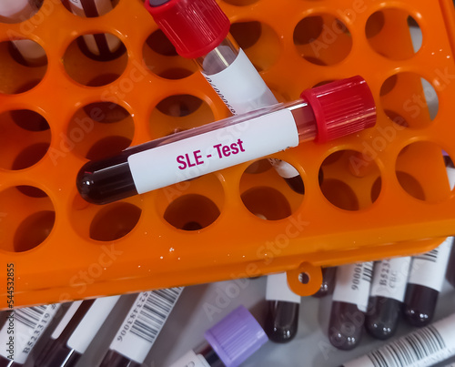 Blood sample for Systemic Lupus Erythematosus (SLE) testing to diagnosis autoimmune disease. photo