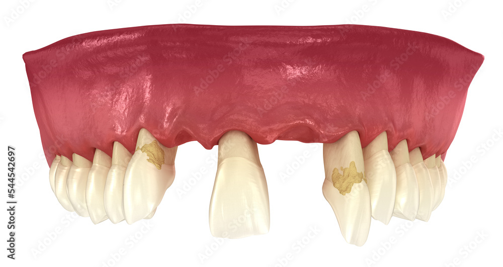 Periodontitis, gum recession and lost teeth. Medically accurate 3D illustration - obrazy, fototapety, plakaty 