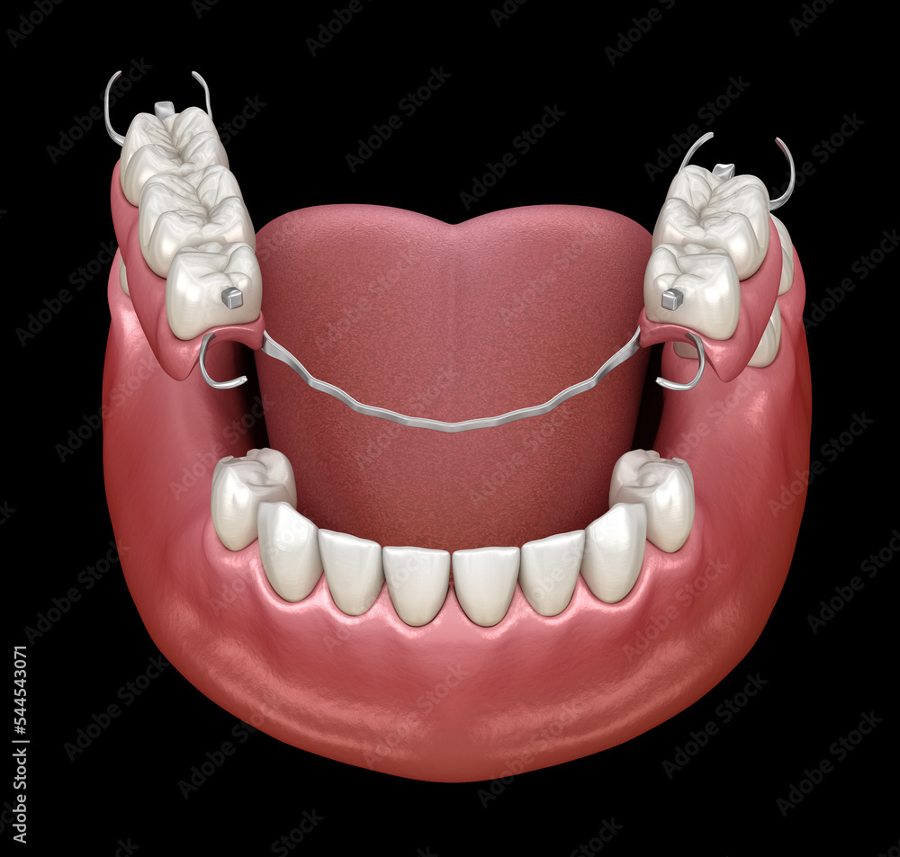 Removable partial denture, mandibular prosthesis. Medically accurate 3D