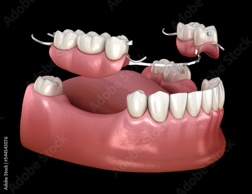 Removable partial denture, mandibular prosthesis. Medically accurate 3D illustration of prosthodontics concept photo
