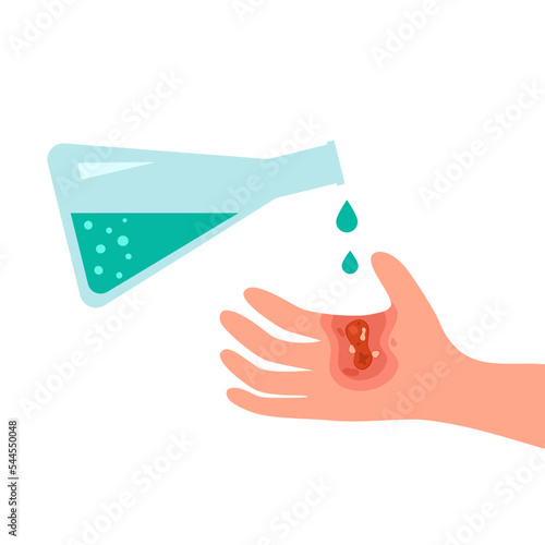 Chemical acid burn on hand skin in flat design on white background.