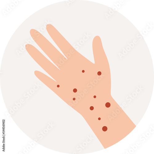 The symptom of the disease is a rash on the hands itching